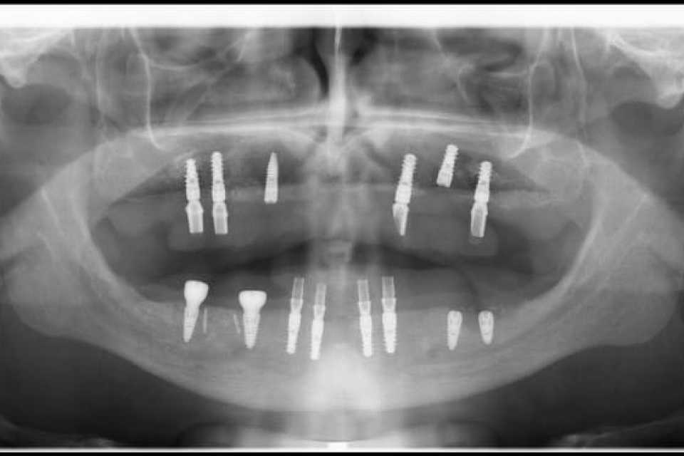 Lucrari fixe cimentate la nivelul maxilarului din ceramica pe zirconiu 1