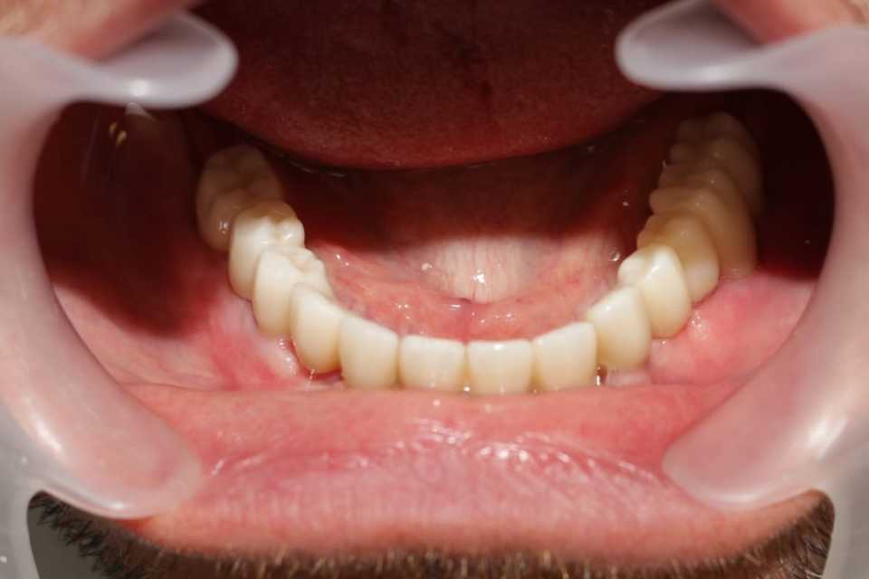 lucrari-fixe-cimentate-ceramica-2