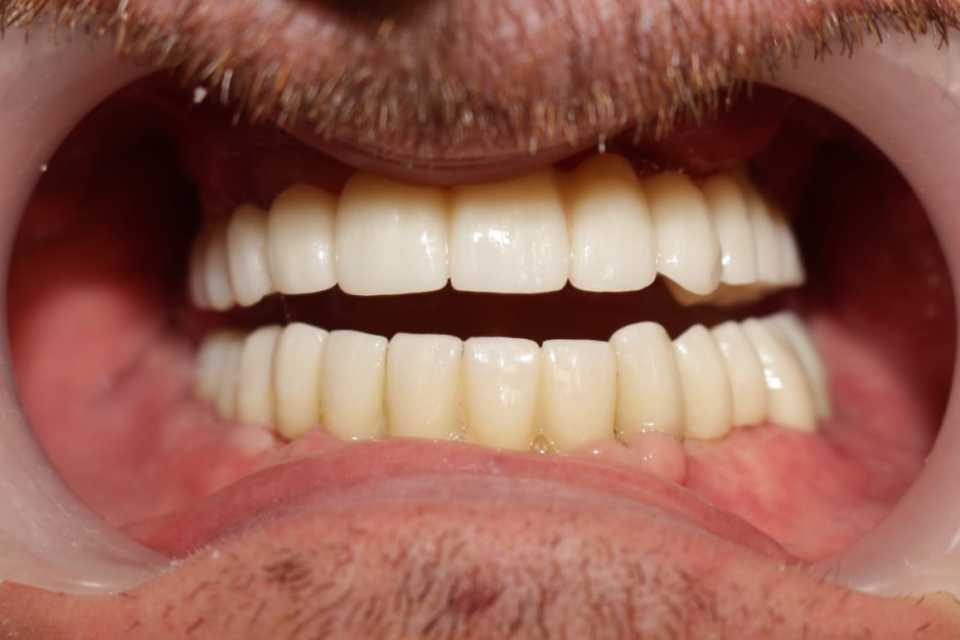 lucrari-fixe-cimentate-ceramica-4