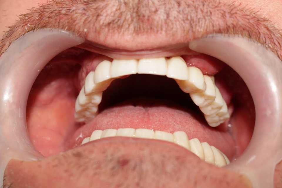 lucrari-fixe-cimentate-ceramica-5