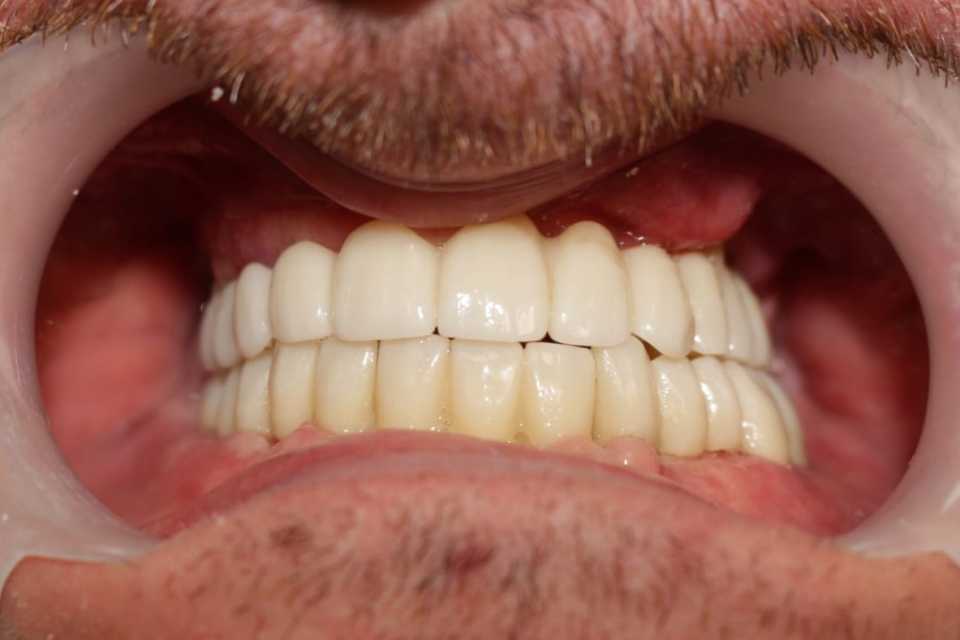 lucrari-fixe-cimentate-ceramica-6