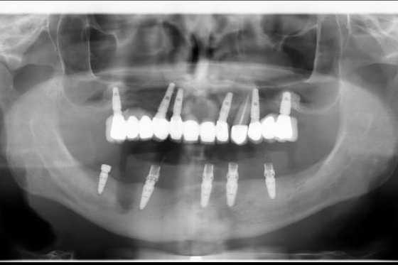 implanturi-megagen-anyridge-ceramice-zirconiu-5