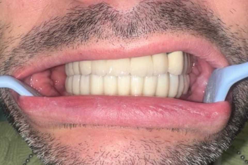 implanturi-megagen-anyridge-ceramice-zirconiu-2
