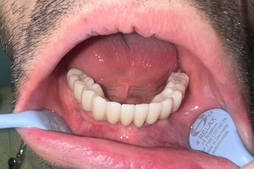 implanturi-megagen-anyridge-ceramice-zirconiu-3