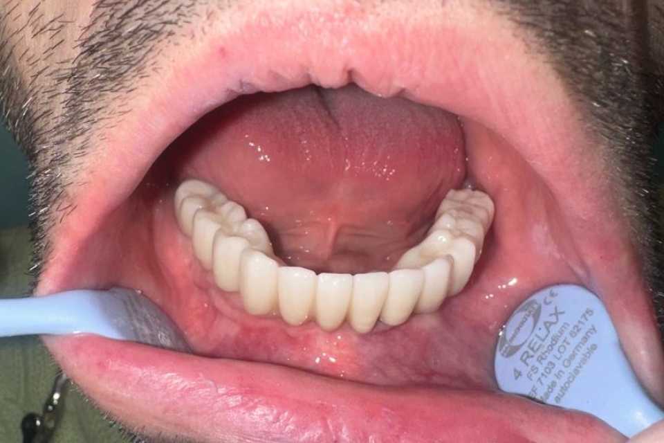 implanturi-megagen-anyridge-ceramice-zirconiu-3