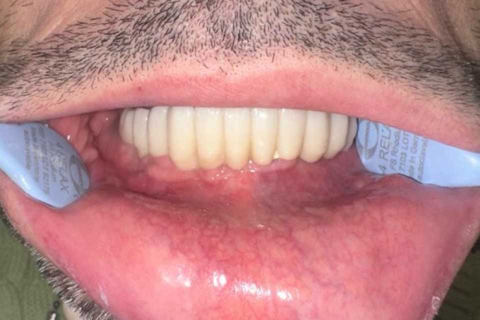 implanturi-megagen-anyridge-ceramice-zirconiu-4