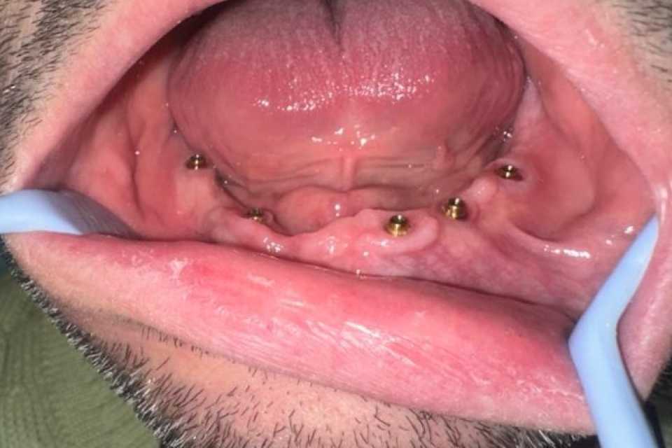 implanturi-megagen-anyridge-ceramice-zirconiu-6