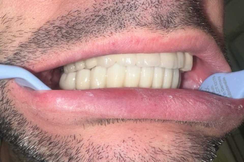 implanturi-megagen-anyridge-ceramice-zirconiu-7
