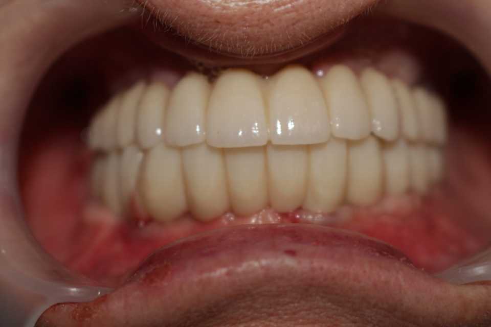 implanturi-punti-fixe-ceramica-zirconiu-1