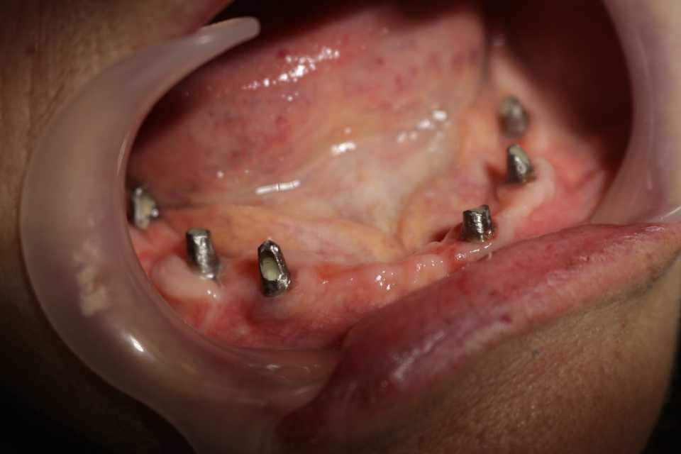 implanturi-punti-fixe-ceramica-zirconiu-2