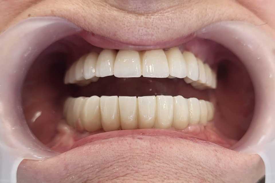 implanturi-punti-fixe-ceramica-zirconiu-4