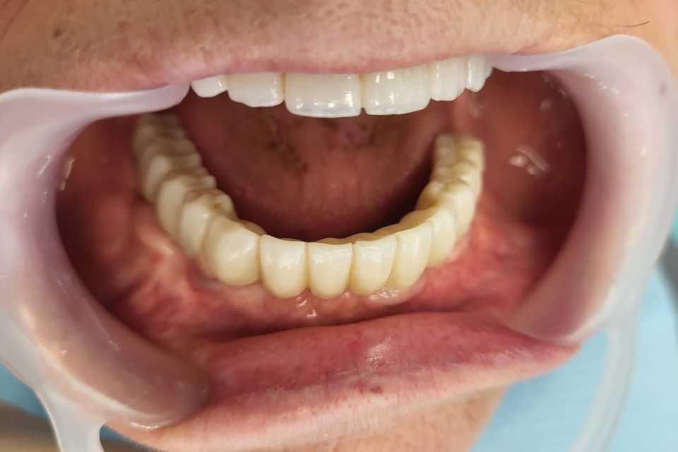implanturi-punti-fixe-ceramica-zirconiu-5