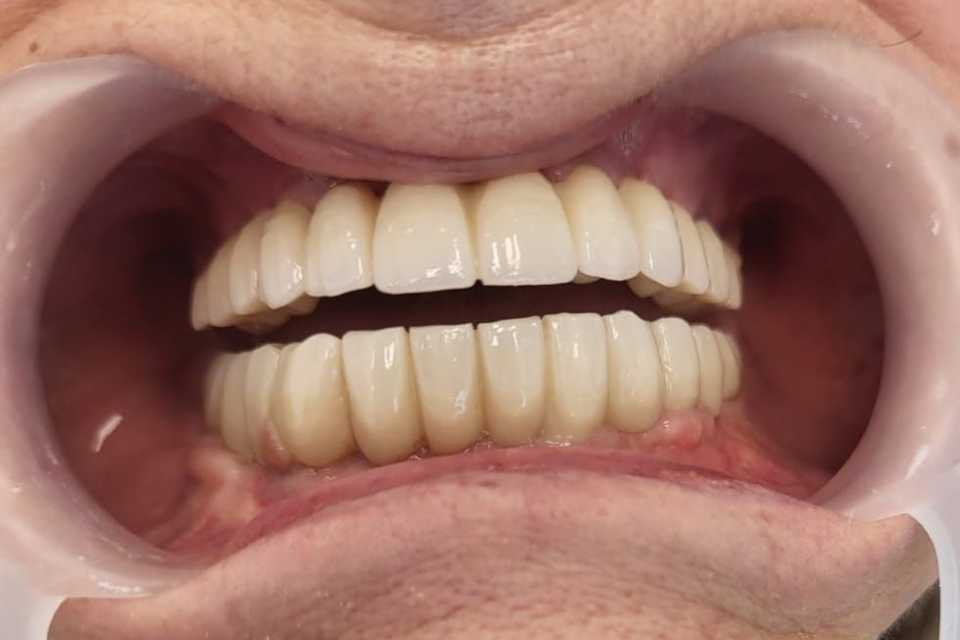 implanturi-punti-fixe-ceramica-zirconiu-6