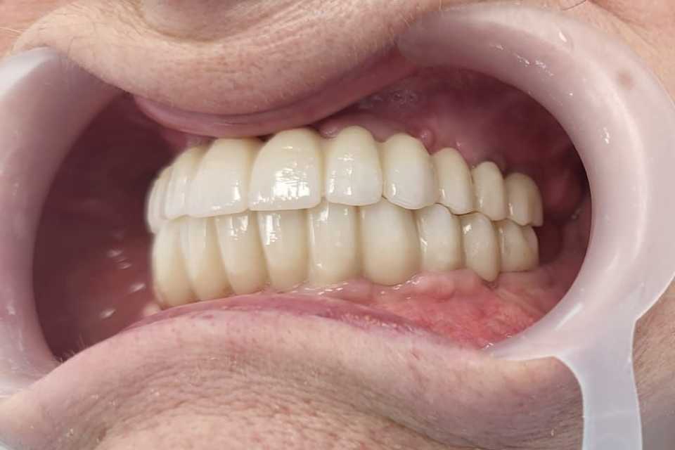 implanturi-punti-fixe-ceramica-zirconiu-7