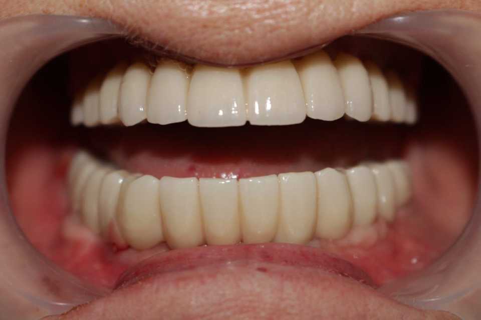 implanturi-punti-fixe-ceramica-zirconiu-8