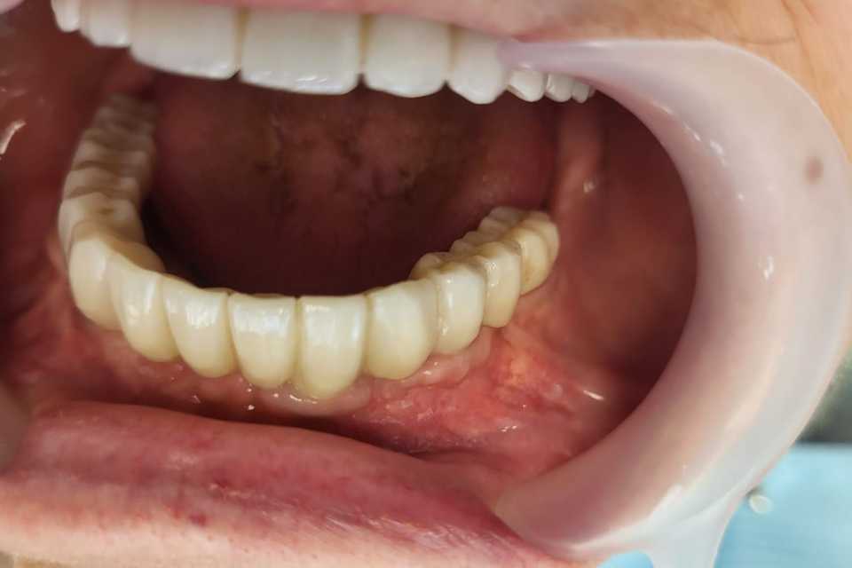 implanturi-punti-fixe-ceramica-zirconiu-10