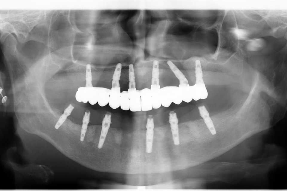 implanturi-punti-fixe-ceramica-zirconiu-11