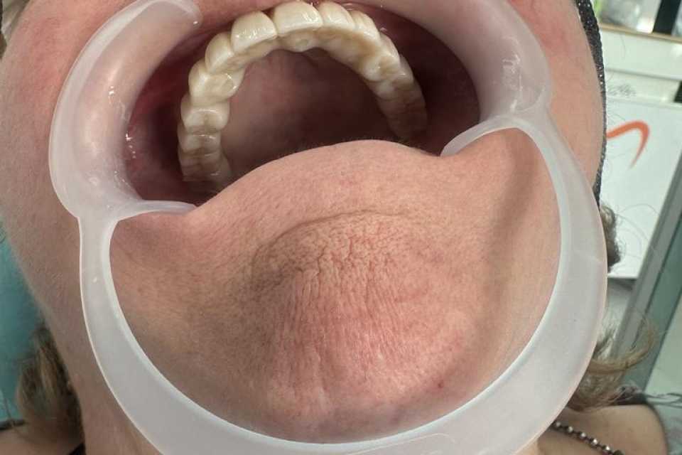 Implanturi orale speciale zigomatice și pterigoide - Poza 001