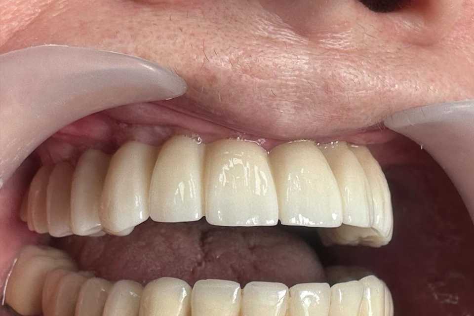 Implanturi orale speciale zigomatice și pterigoide - Poza 002