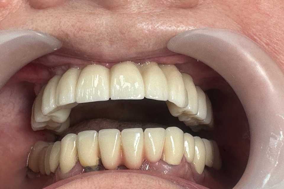 Implanturi orale speciale zigomatice și pterigoide - Poza 008