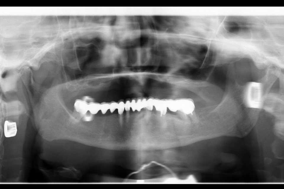 Implanturi orale speciale zigomatice și pterigoide - Poza 010