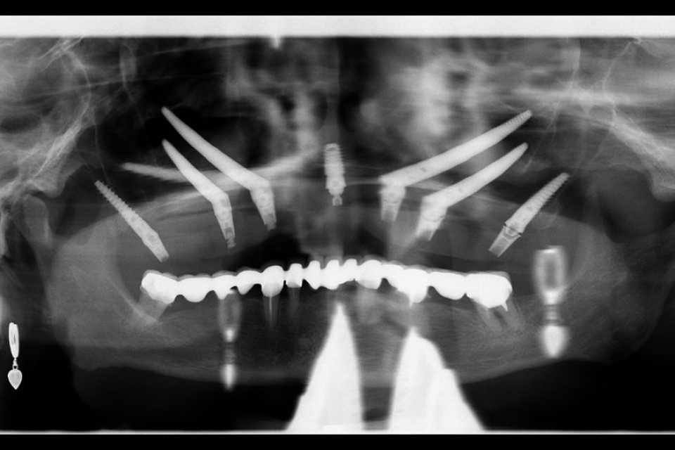 Implanturi orale speciale zigomatice și pterigoide - Poza 011