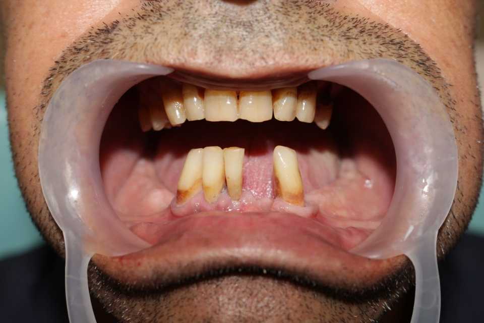 Reabilitare orală cu implanturi dentare Paltop - Poza 003
