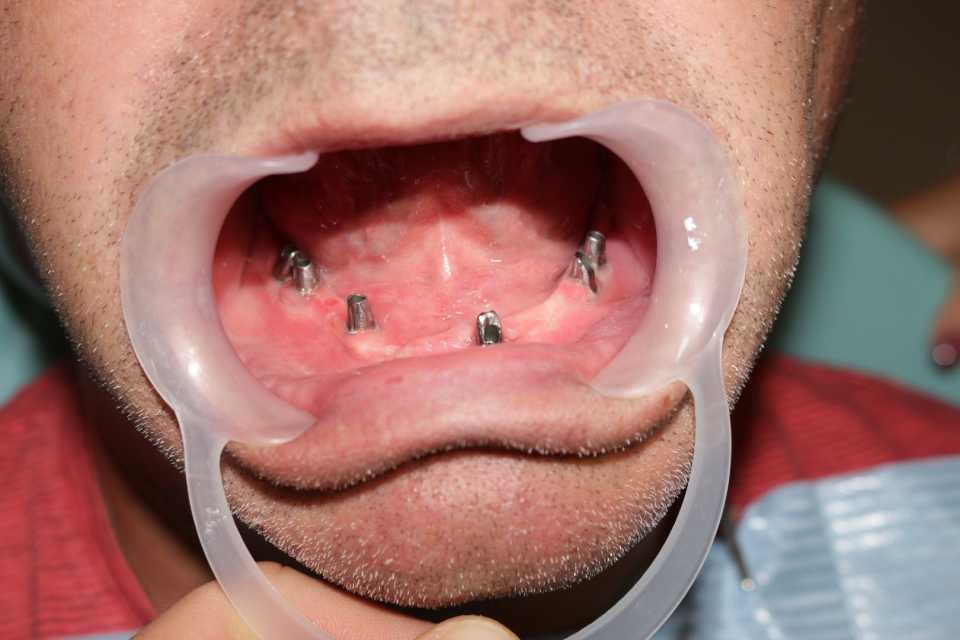 Reabilitare orală cu implanturi dentare Paltop - Poza 004