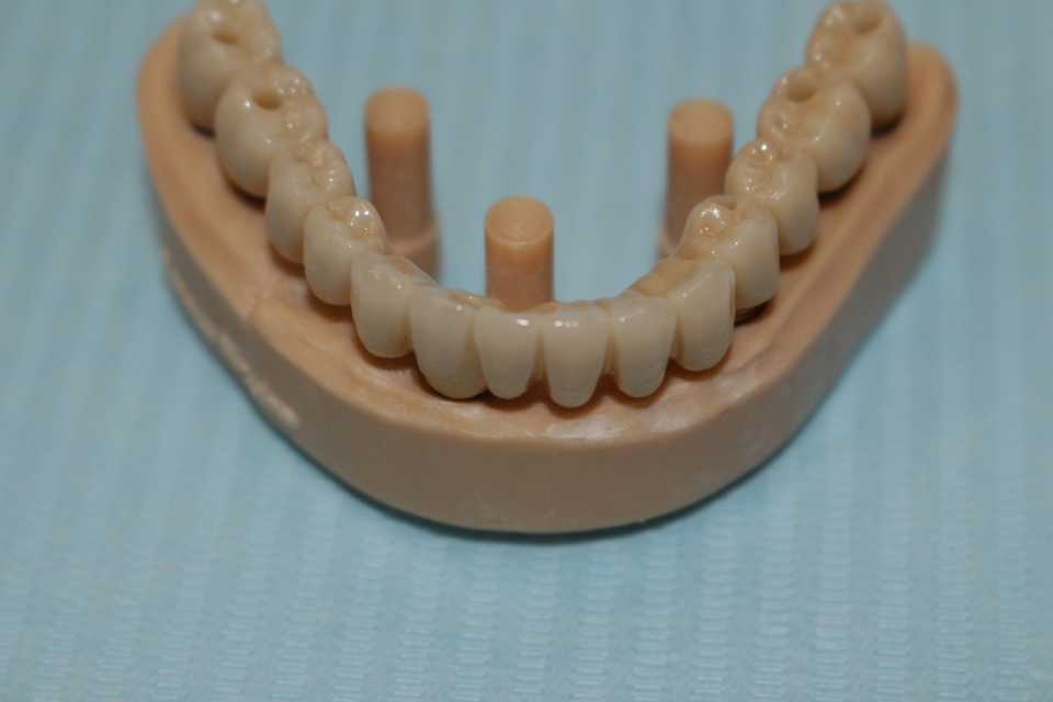 Reabilitare orală cu implanturi dentare Paltop - Poza 006