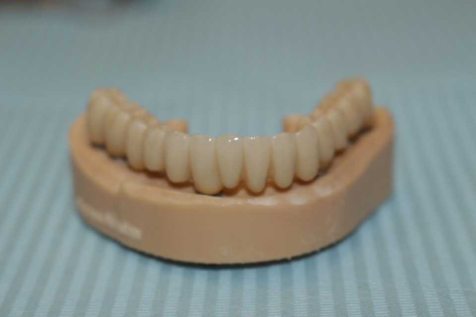 Reabilitare orală cu implanturi dentare Paltop - Poza 007