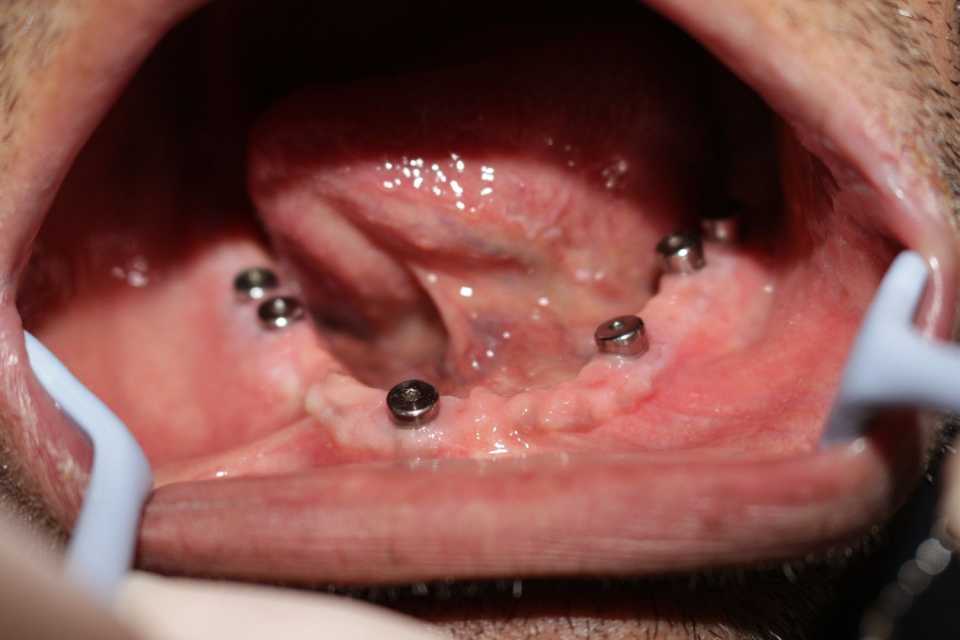 Reabilitare orală cu implanturi dentare Paltop - Poza 008