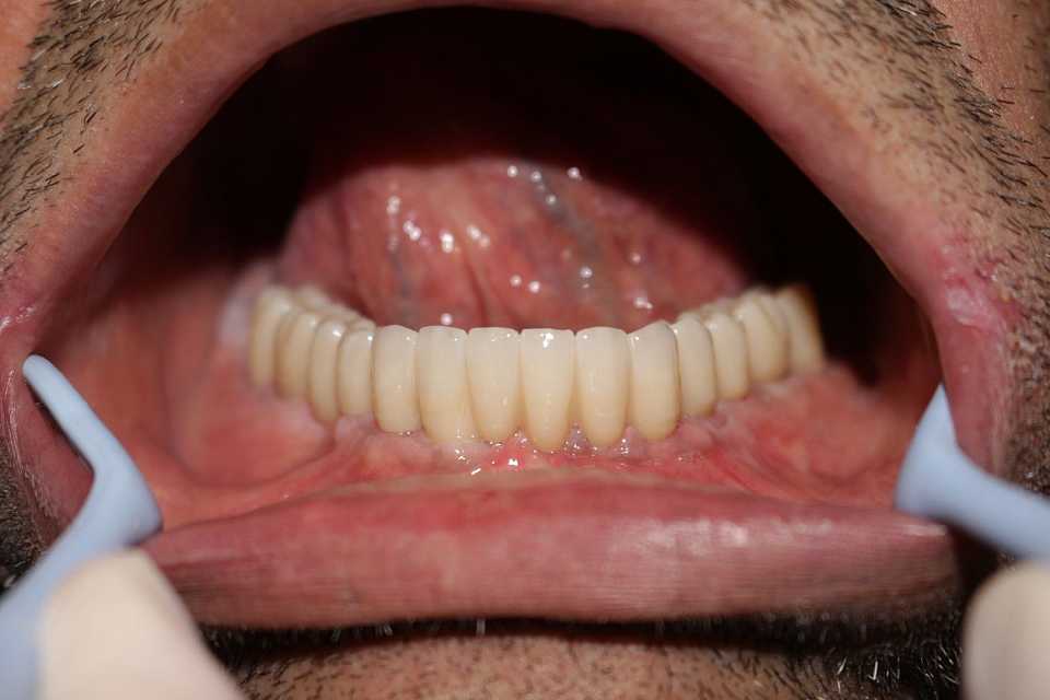Reabilitare orală cu implanturi dentare Paltop - Poza 009