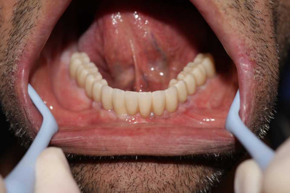 Reabilitare orală cu implanturi dentare Paltop - Poza 010
