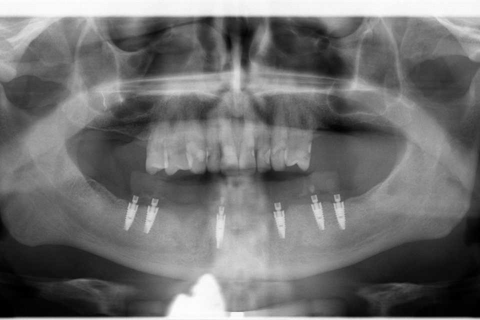 Reabilitare orală cu implanturi dentare Paltop - Poza 001