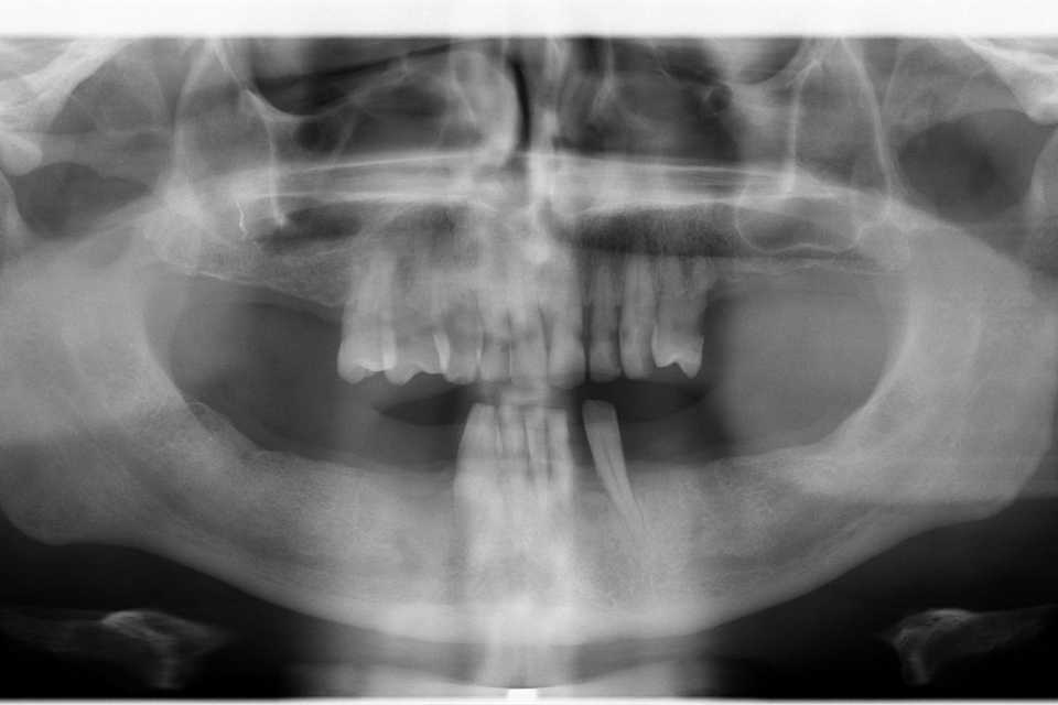 Reabilitare orală cu implanturi dentare Paltop - Poza 002
