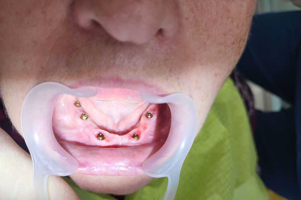 Reabilitare implaturi Anyridge - Poza 001