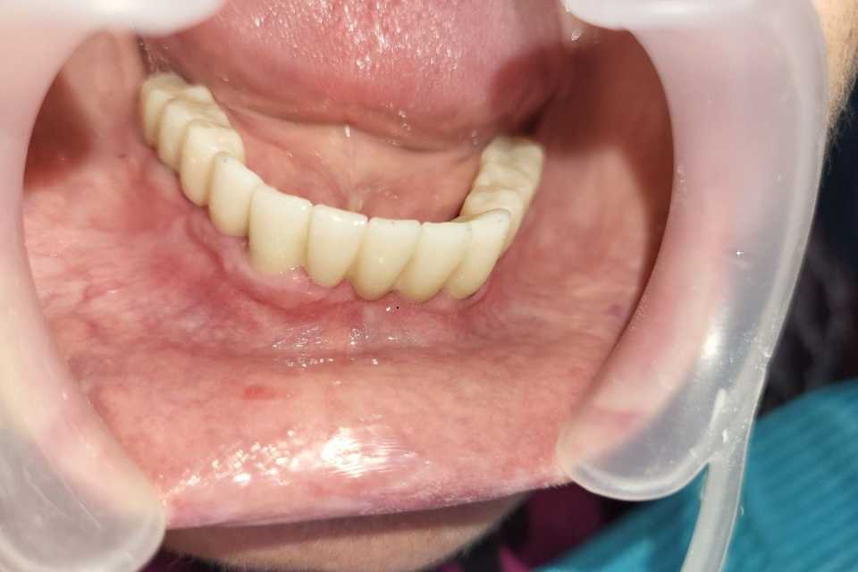 Reabilitare implaturi Anyridge - Poza 003