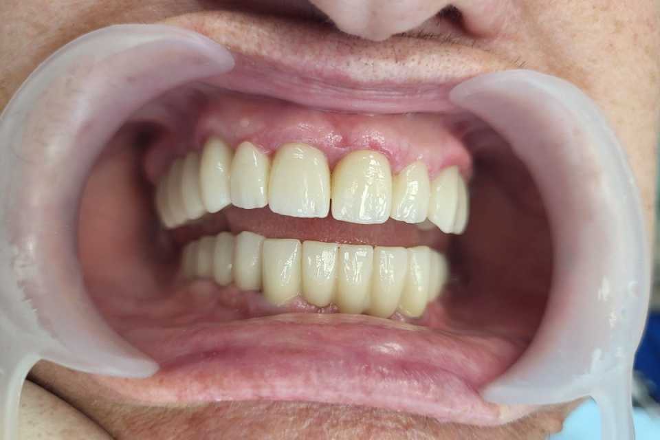 Reabilitare implaturi Anyridge - Poza 007