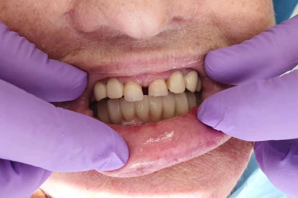 Reabilitare implaturi Anyridge - Poza 010