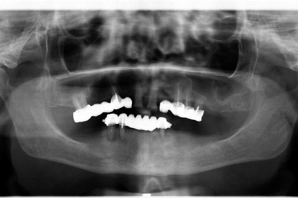 Reabilitare implaturi Anyridge - Poza 011