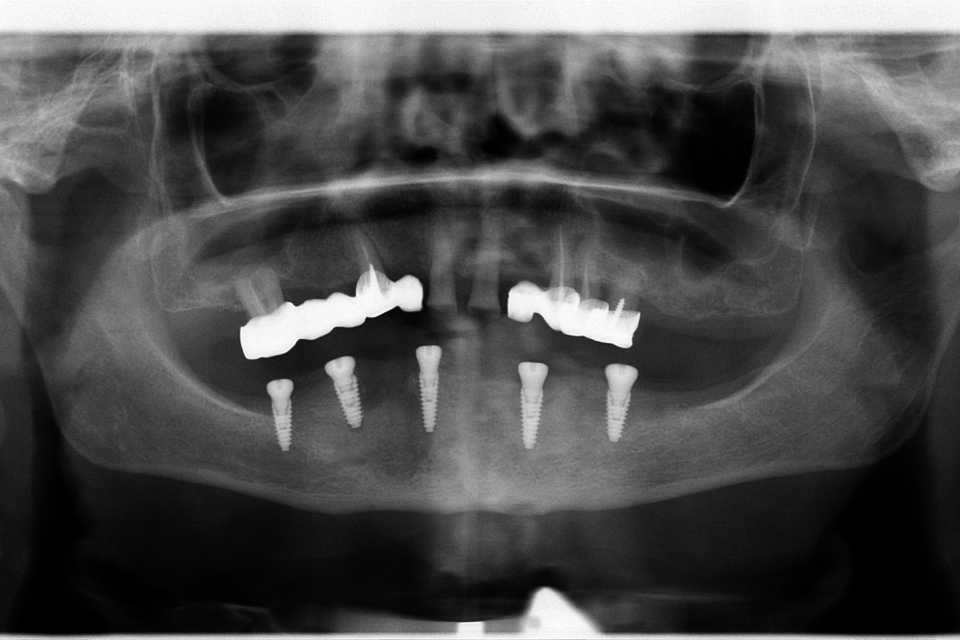Reabilitare implaturi Anyridge - Poza 012
