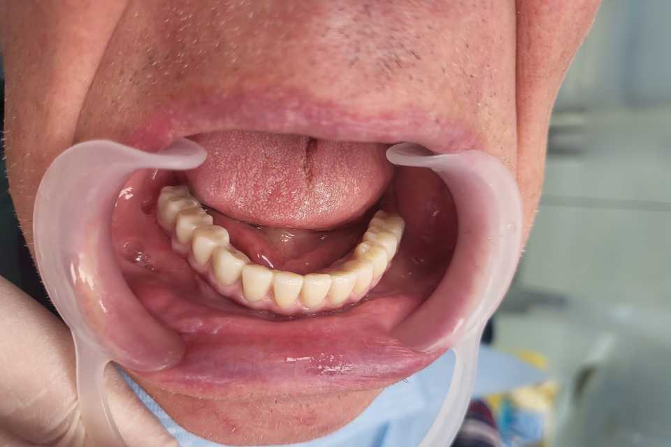 Implanturi mandibulă și lucrare înșurabilă ceramică - Poza 002