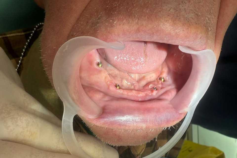 Implanturi mandibulă și lucrare înșurabilă ceramică - Poza 003