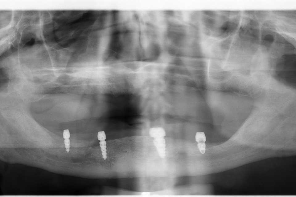Implanturi mandibulă și lucrare înșurabilă ceramică - Poza 004