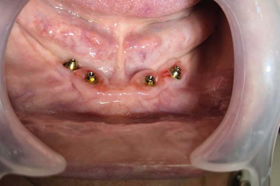 Implanturi AnyRidge inserate interforaminal - Poza 001