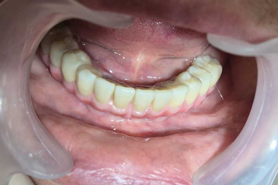 Implanturi AnyRidge inserate interforaminal - Poza 004