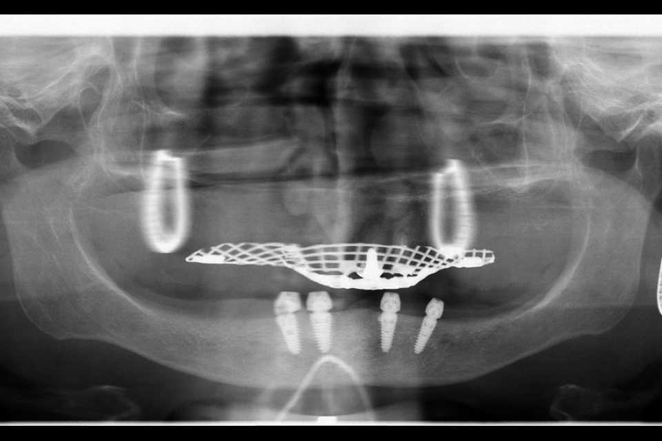 Implanturi AnyRidge inserate interforaminal - Poza 008