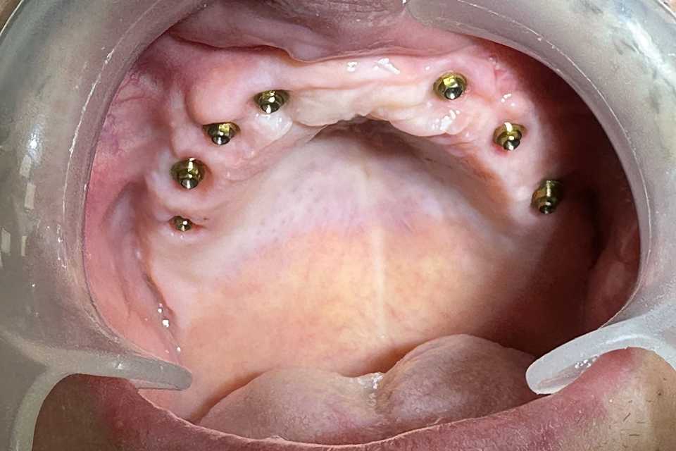 Implaturi si sinus lift - Poza 004