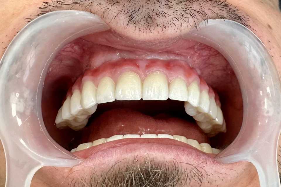 Implaturi si sinus lift - Poza 005