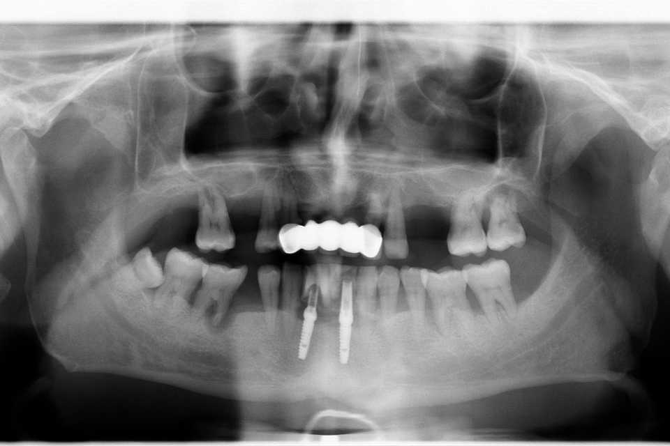 Implaturi si sinus lift - Poza 002